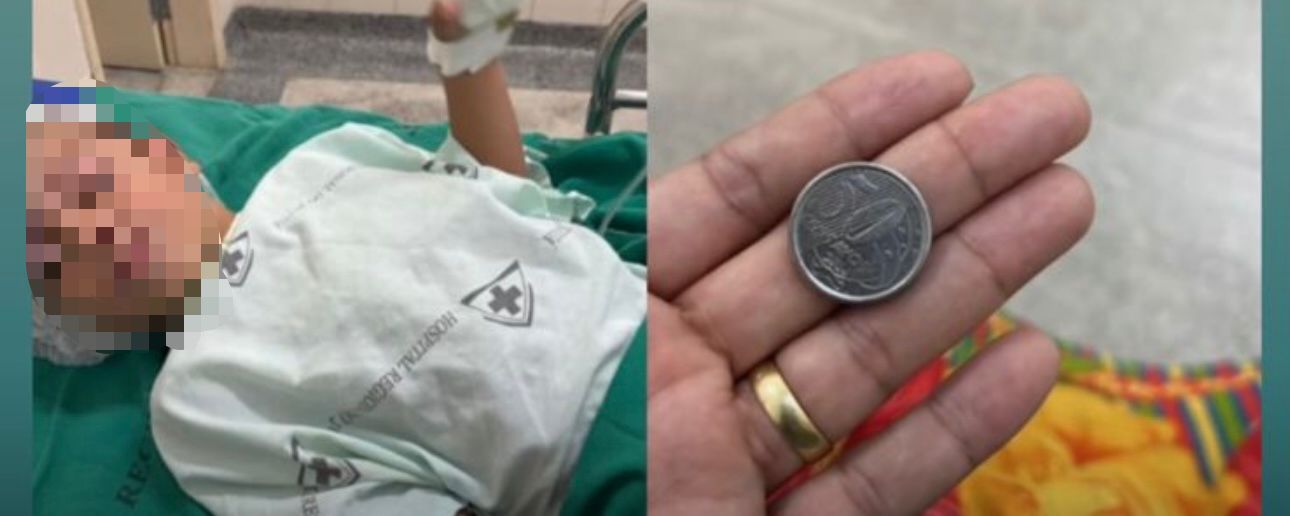 Criança de 5 anos engole moeda em Mâncio Lima e passa por procedimento para retirada no Hospital do Juruá