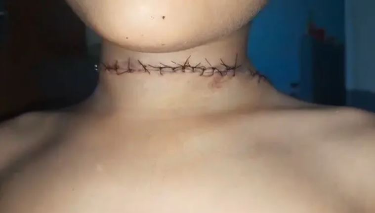 Menino de 6 anos leva 20 pontos no pescoço após ser ferido por linha de pipa com cerol